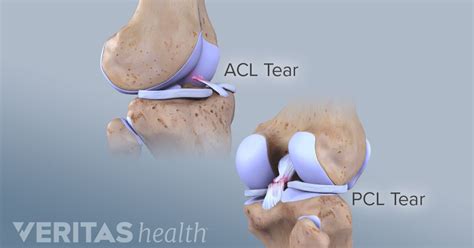 signs of pcl injury